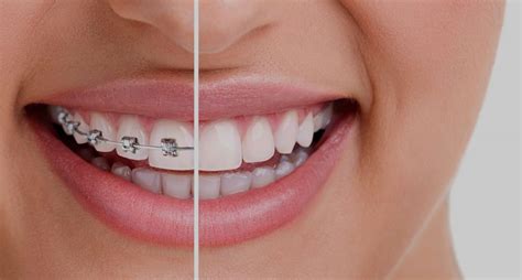 best orthodontist near 10930|Teeth Straightening 